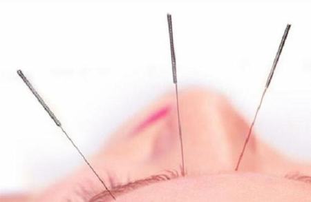 طب سوزنی،اخبار پزشکی ،خبرهای پزشکی طب سوزنی,اخبار پزشکی ,خبرهای پزشکی