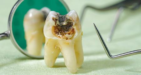 پوسیدگی دندان،اخبار پزشکی،خبرهای پزشکی