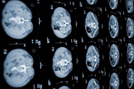 تشخیص زودهنگام سرطان لوزالمعده با مدل جدید هوش مصنوعی،اخبار پزشکی،خبرهای پزشکی تشخیص زودهنگام سرطان لوزالمعده با مدل جدید هوش مصنوعی،اخبار پزشکی،خبرهای پزشکی