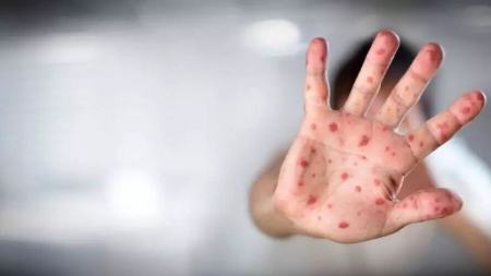 آبله مرغان،اخبار پزشکی،خبرهای پزشکی آبله مرغان،اخبار پزشکی،خبرهای پزشکی