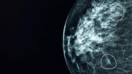 معجزه جدید هوش مصنوعی برای سلامتی زنانهوش مصنوعی سرطان پستان ۱۱ زن را تشخیص داد. به گزارش اطلاعات به نقل از بی بی سی،…