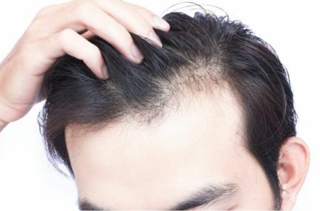 توقف ریزش مو،اخبار پزشکی،خبرهای پزشکی توقف ریزش مو،اخبار پزشکی،خبرهای پزشکی