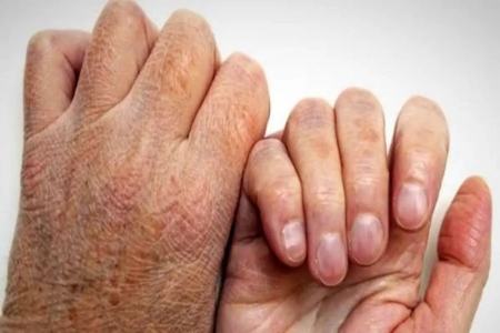 جذام،اخبار پزشکی،خبرهای پزشکی جذام،اخبار پزشکی،خبرهای پزشکی