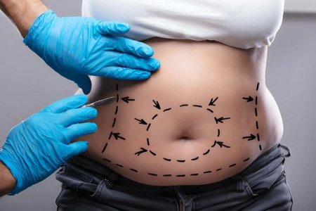 لیفت شقیقه لیفت شقیقه