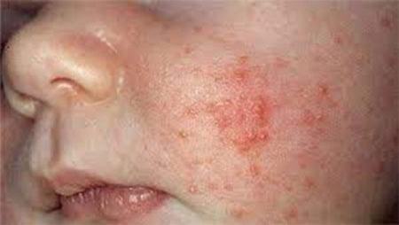 شیوع سرخک در عراق،اخبار پزشکی،خبرهای پزشکی شیوع سرخک در عراق،اخبار پزشکی،خبرهای پزشکی