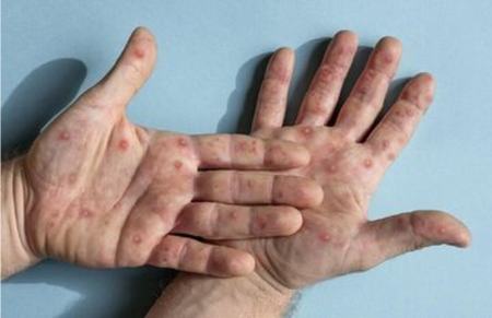 آبله میمونی،اخبار پزشکی،خبرهای پزشکی