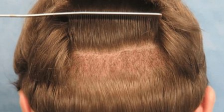 تراکم کاشت مو در کلینیک پروشات تراکم کاشت مو در کلینیک پروشات