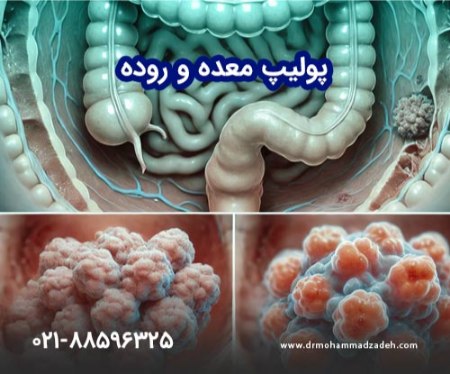 تشخیص پولیپ با آندوسکوپی با بیهوشی