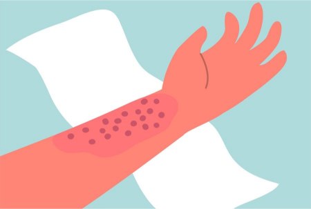 چگونه گاز استریل چسبیده به بخیه را جدا کنیم؟