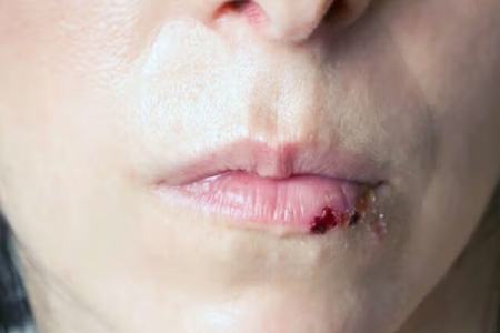 لب،اخبار پزشکی،خبرهای پزشکی