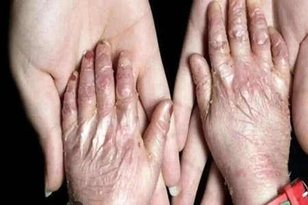 بیماری نادر،اخبار پزشکی،خبرهای پزشکی بیماری نادر،اخبار پزشکی،خبرهای پزشکی