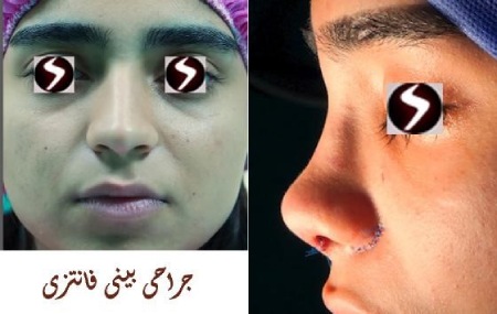 جراحی بینی فانتزی چیست جراحی بینی فانتزی چیست