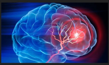 سکته مغزی ،اخبار پزشکی ،خبرهای پزشکی سکته مغزی ,اخبار پزشکی ,خبرهای پزشکی
