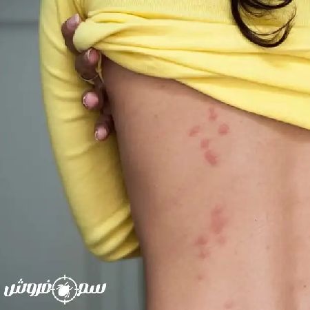 عکس جای نیش ساس عکس جای نیش ساس