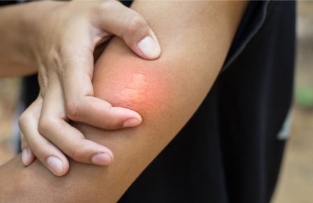 آلرژی به نیش حشرات چیست و چه علائمی را در فرد ایجاد میکند؟ آلرژی به نیش حشرات چیست و چه علائمی را در فرد ایجاد میکند؟