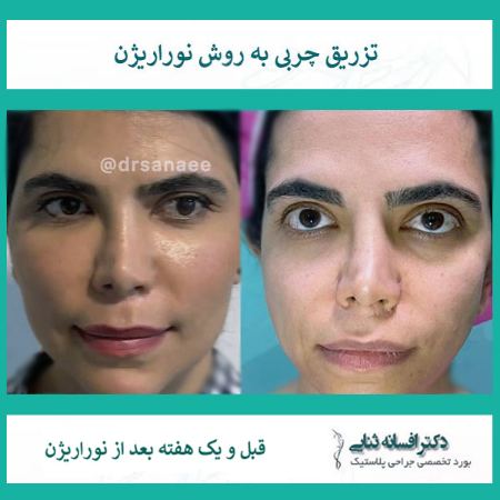 عکس تزریق چربی به صورت به روش نوراریژن و نتیجه چشمگیر آن در جوانسازی و زیبایی صورت عکس تزریق چربی به صورت به روش نوراریژن و نتیجه چشمگیر آن در جوانسازی و زیبایی صورت