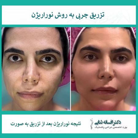 تصویر صورت بعد از تزریق چربی به روش نوراریژن - جوانسازی و زیبایی تصویر صورت بعد از تزریق چربی به روش نوراریژن - جوانسازی و زیبایی