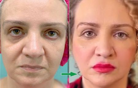 تصویر قبل و بعد از تزریق چربی به روش نوراریژن تصویر قبل و بعد از تزریق چربی به روش نوراریژن