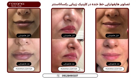 عکس قبل و بعد هایفوتراپی کلینیک رکسانا