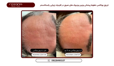 عکس قبل و بعد بوتاکس کلینک رکسانا