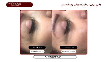 عکس قبل و بعد پلاژن تراپی