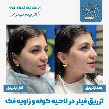 کانتورینگ صورت دکتر میعاد مهدوی کانتورینگ صورت دکتر میعاد مهدوی