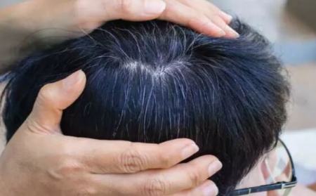 سفیدی موی سر،اخبار پزشکی،خبرهای پزشکی سفیدی موی سر،اخبار پزشکی،خبرهای پزشکی