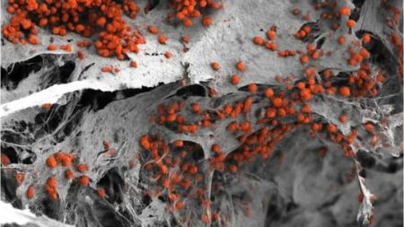 سرطان خون،اخبار پزشکی،خبرهای پزشکی