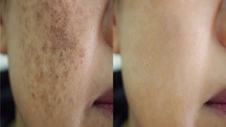 اسید تراپی پوست برای لک اسید تراپی پوست برای لک