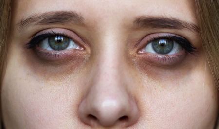 علت سیاهی زیر چشم علت سیاهی زیر چشم