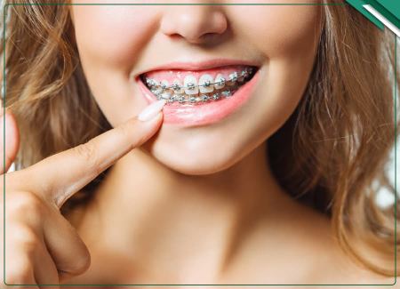 تأثیر ارتودنسی بر زیبایی و اعتماد به نفس | لبخند زیبا، چهره جوان‌تر