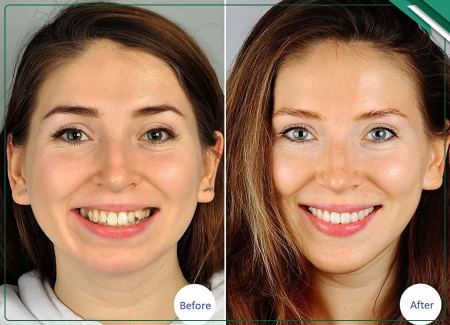 تغییر در فرم لب‌ها با ارتودنسی