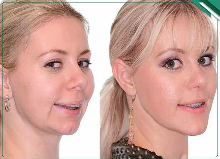 تغییر در گونه‌ها و بینی با ارتودنسی