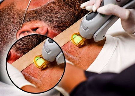 چگونه از عوارض لیزر صورت جلوگیری کنیم؟ چگونه از عوارض لیزر صورت جلوگیری کنیم؟