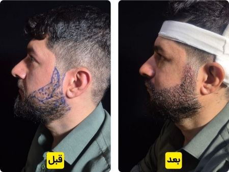 کاشت ریش و سبیل دائمی