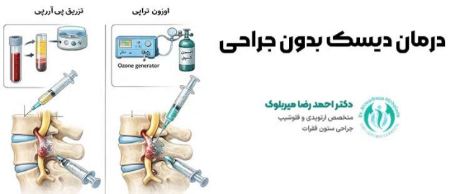 درمان دیسک بدون جراحی توسط دکتر احمدرضا میربلوک