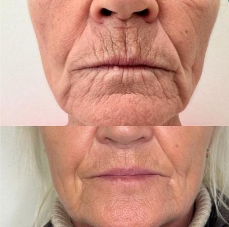 بوتاکس لب بوتاکس لب