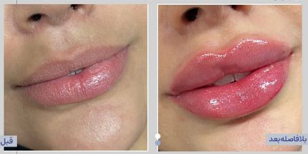 فیلر لب فیلر لب