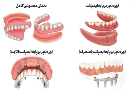 اوردنچر با ایمپلنت برای سالمندان اوردنچر با ایمپلنت برای سالمندان