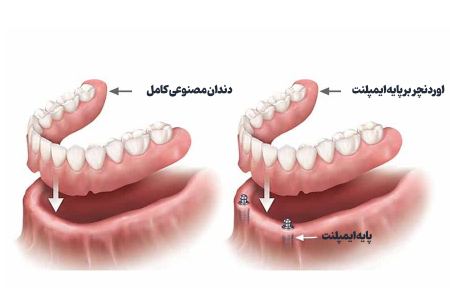 کاشت ایمپلنت دندان سالمندان کاشت ایمپلنت دندان سالمندان