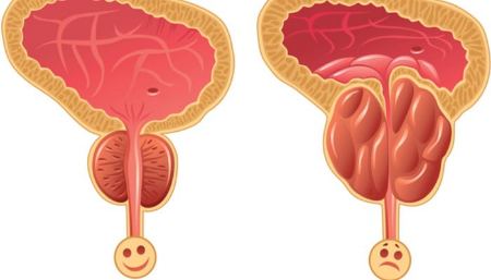 درمان پروستات