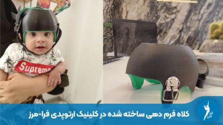 ساخت کلاه فرم دهی در کلینیک ارتوپدی فنی شیراز