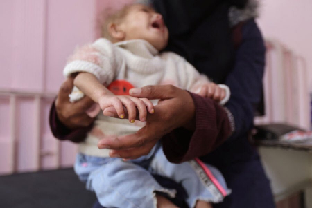 عکسهای جالب,عکسهای جذاب,کودک فلسطینی با سوء تغذیه شدید 