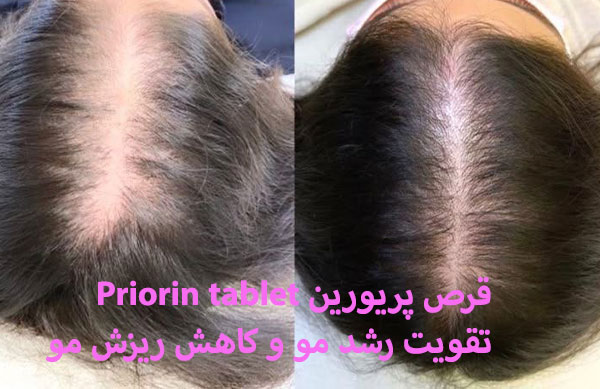 قرص پریورین چیست؟ خواص، عوارض، نحوه مصرف، نتایج و نظرات