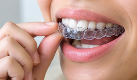 تفاوت ارتودنسی ثابت و متحرک