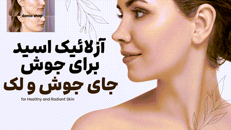 آزلائیک اسید برای بهبود جوش و جای جوش و لک
