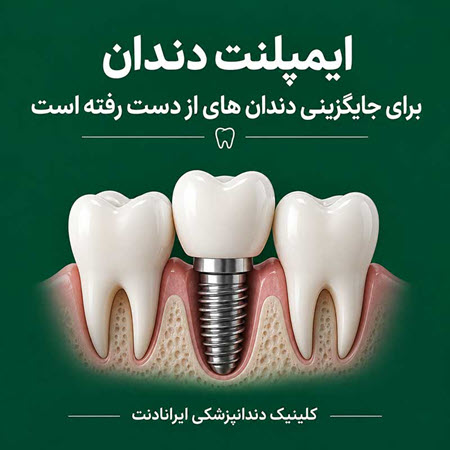 اگر دندان از دست رفته باشد بهترین راهکار برای جایگزینی ایمپلنت دندان است