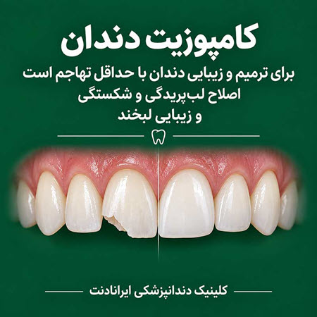 چه زمانی بجای کامپوزیت، دندان را لمینت می کنند؟