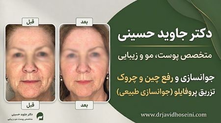 نمونه کار تزریق پروفایلو دکتر جاوید حسینی نمونه کار تزریق پروفایلو دکتر جاوید حسینی