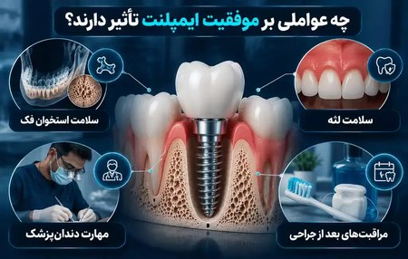 عوامل تاثیرگذار بر موفقیت ایمپلنت دندان عوامل تاثیرگذار بر موفقیت ایمپلنت دندان